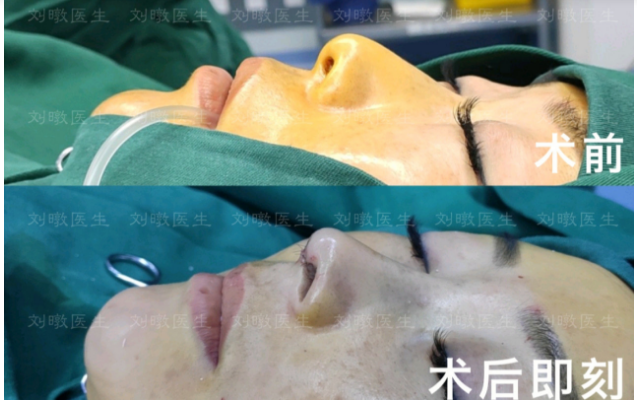 劉暾鼻修復案例