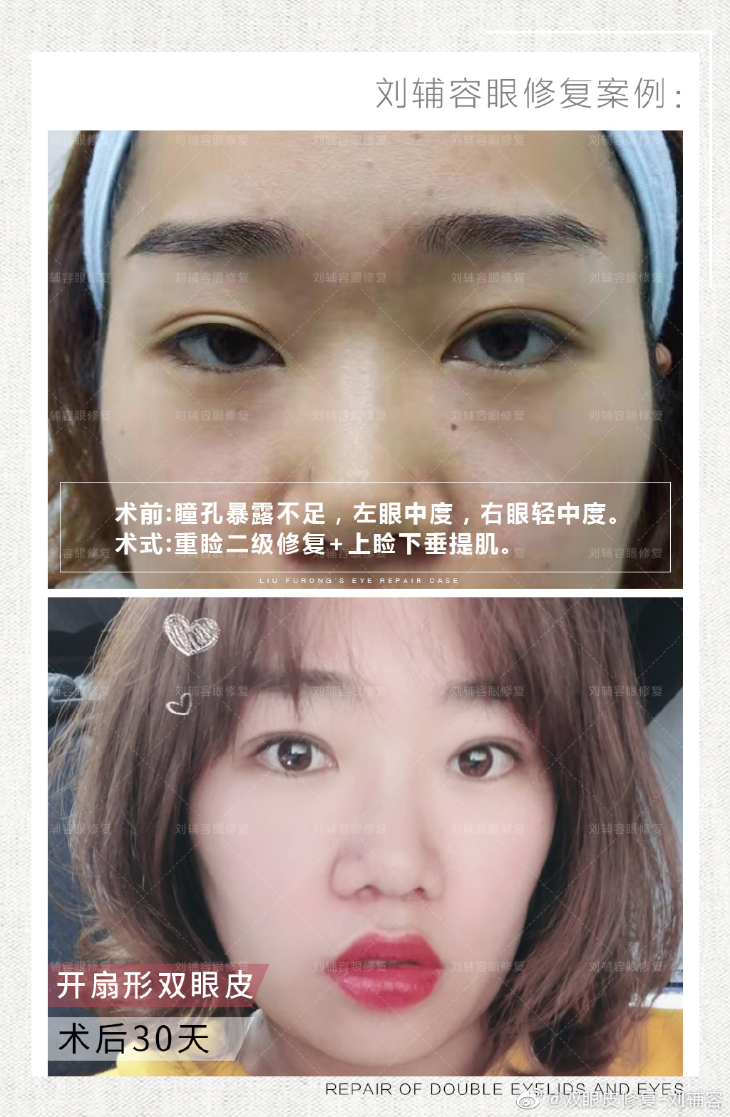 劉輔容眼修復(fù)案例
