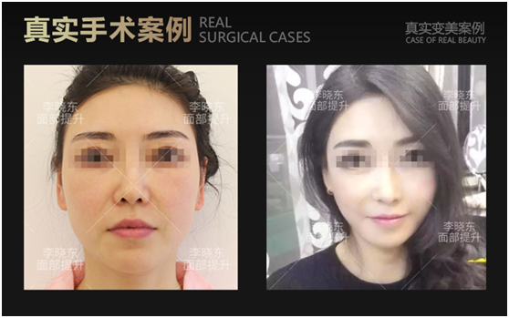 李曉東和楊博哪個(gè)面部提升更好？