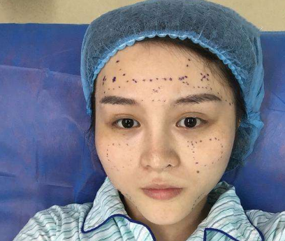 上海哪個醫生做脂肪填充好？
