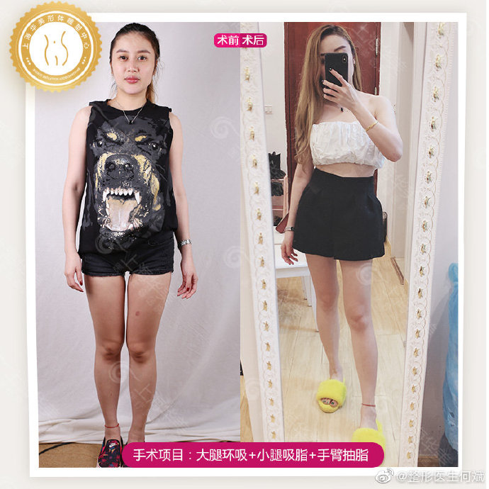 上海吸脂最厲害的醫(yī)院，上海大腿吸脂多少錢(qián)？