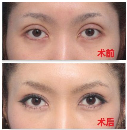 深圳雙眼皮修復哪位醫生比較好？深圳雙眼皮修復專家排行榜