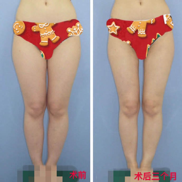 北京八大處大腿吸脂醫生哪個好？北京八大處大腿吸脂醫生排行榜