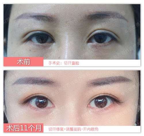 南京雙眼皮修復哪個醫生最好？