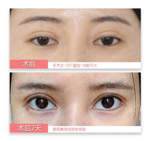 合肥雙眼皮修復哪個醫生專家做的好?