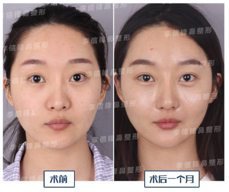 李信峰鼻綜合案例