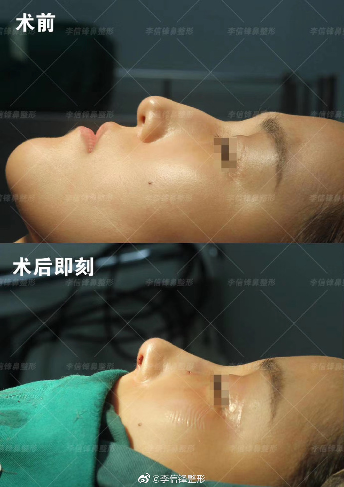 李信峰鼻綜合案例