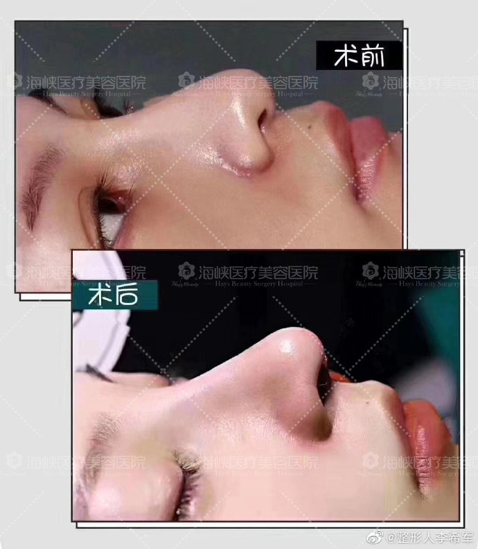 李希軍隆鼻案例