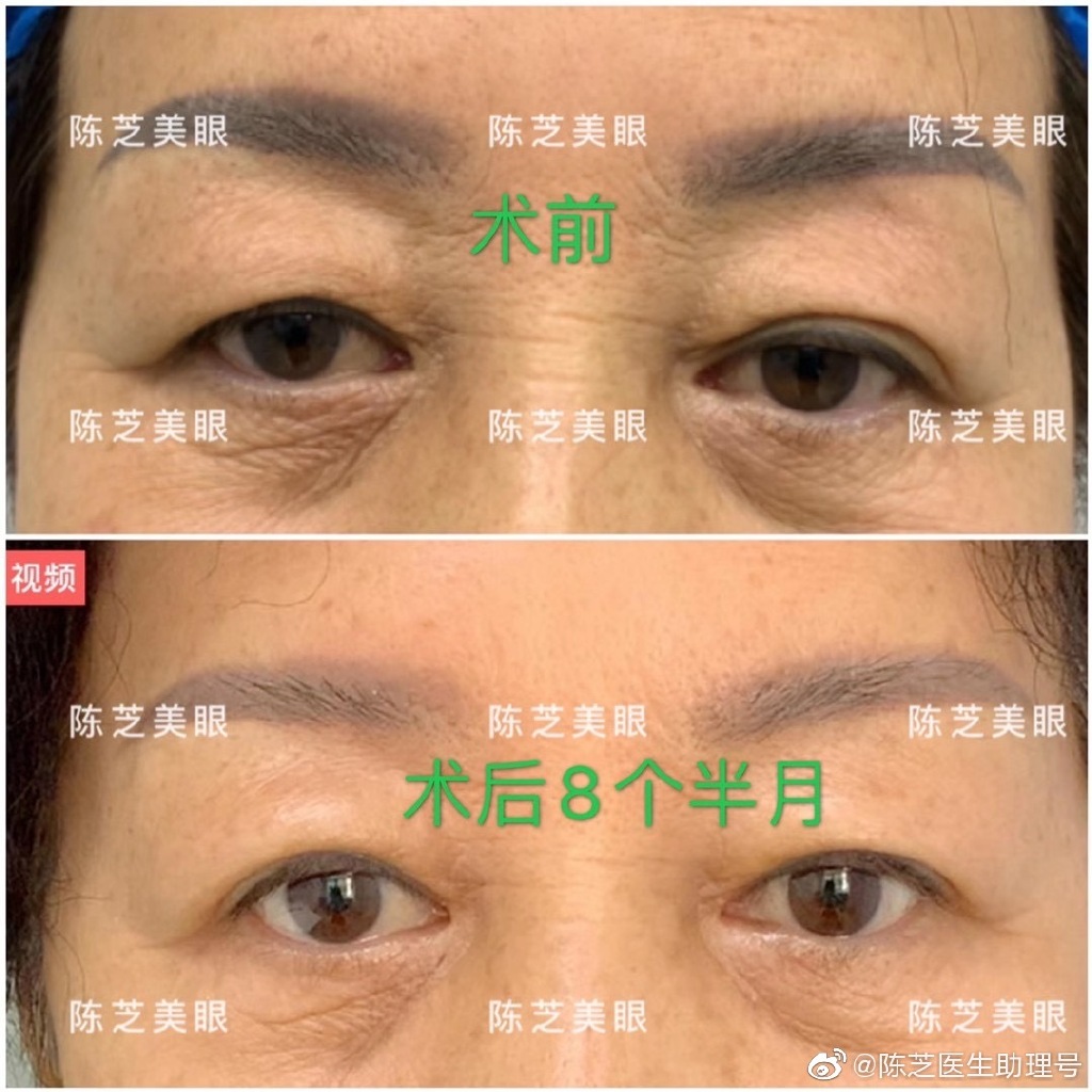 陳芝雙眼皮案例