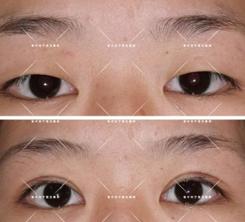王金明割雙眼皮案例