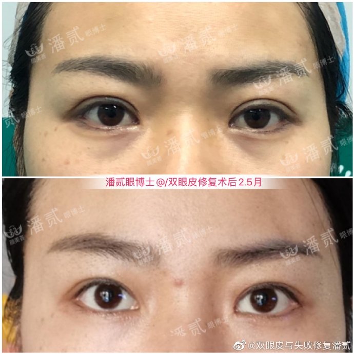 潘貳雙眼皮修復(fù)案例