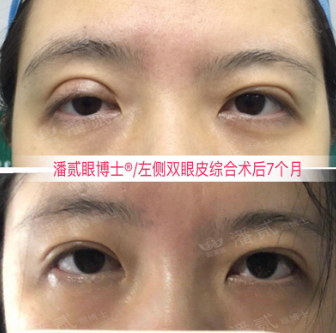 潘貳雙眼皮修復(fù)案例