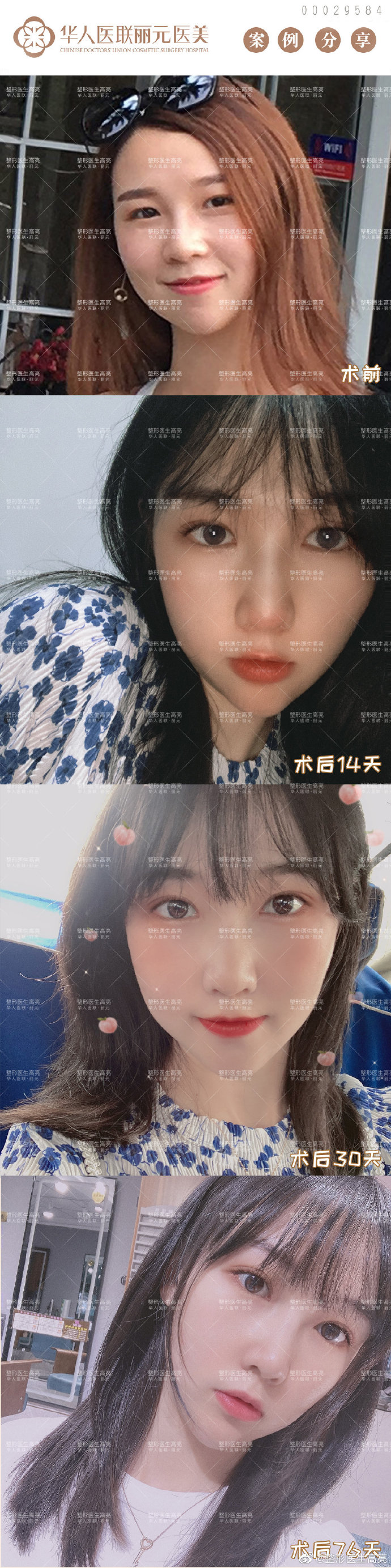 高亮眼修復(fù)案例