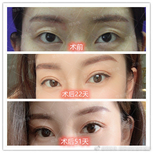 鄧東偉割雙眼皮案例