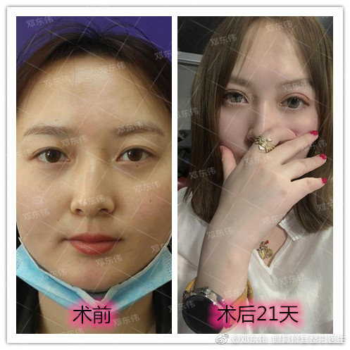 鄧東偉全切雙眼皮案例