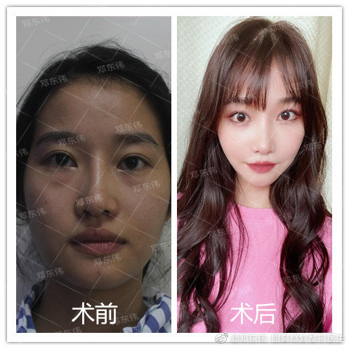 鄧東偉鼻修復(fù)案例