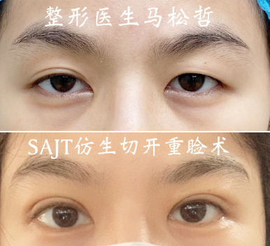 馬松哲雙眼皮案例