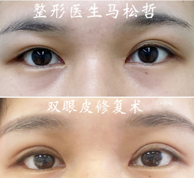 馬松哲眼修復案例