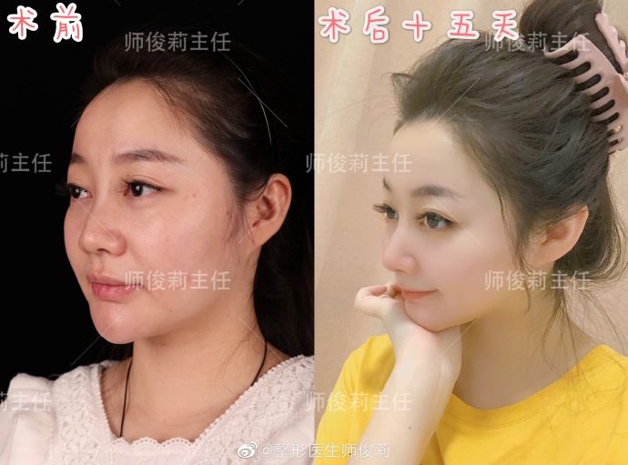 師俊麗鼻整形案例