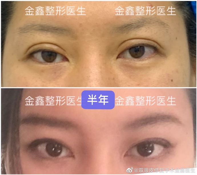 金鑫眼修復案例