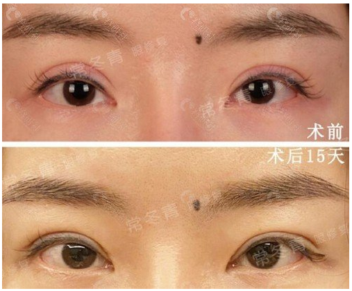 常冬青雙眼皮修復(fù)案例