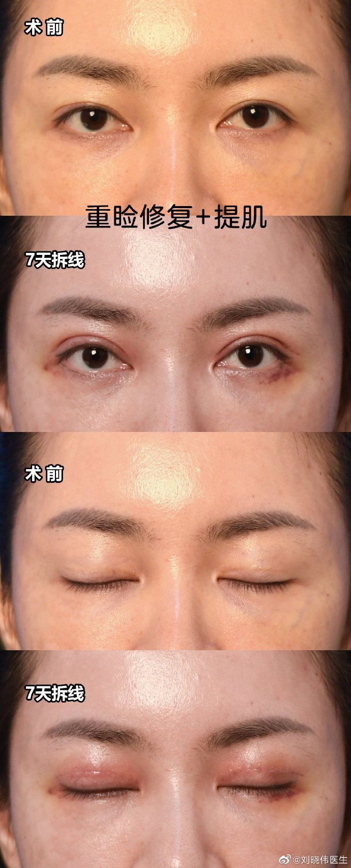 劉曉偉做眼修復案例