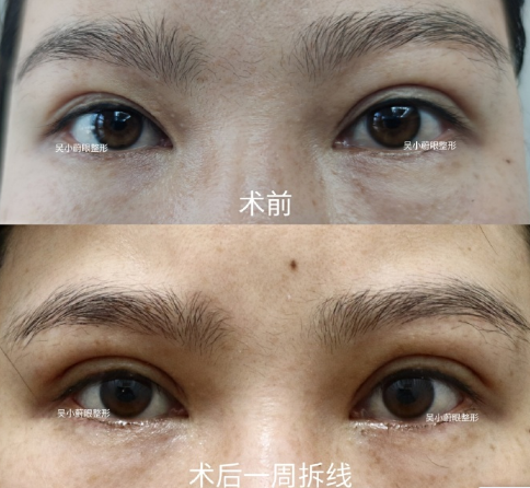 武漢修復雙眼皮好的專家是誰