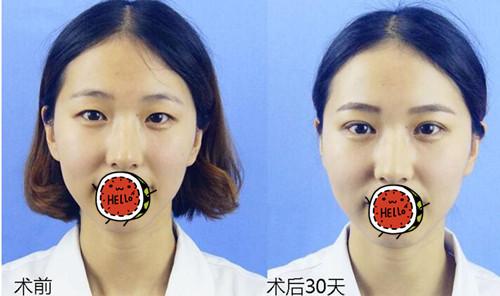王大勇割雙眼皮案例