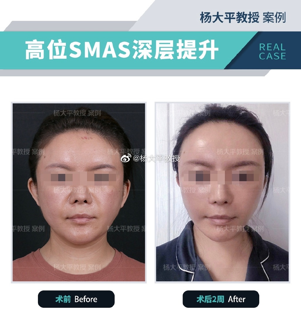 楊大平面部提升案例