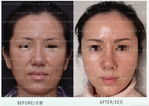 潘彥龍面部提升案例