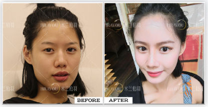 雙眼皮高亮和盧尚兵哪個技術好