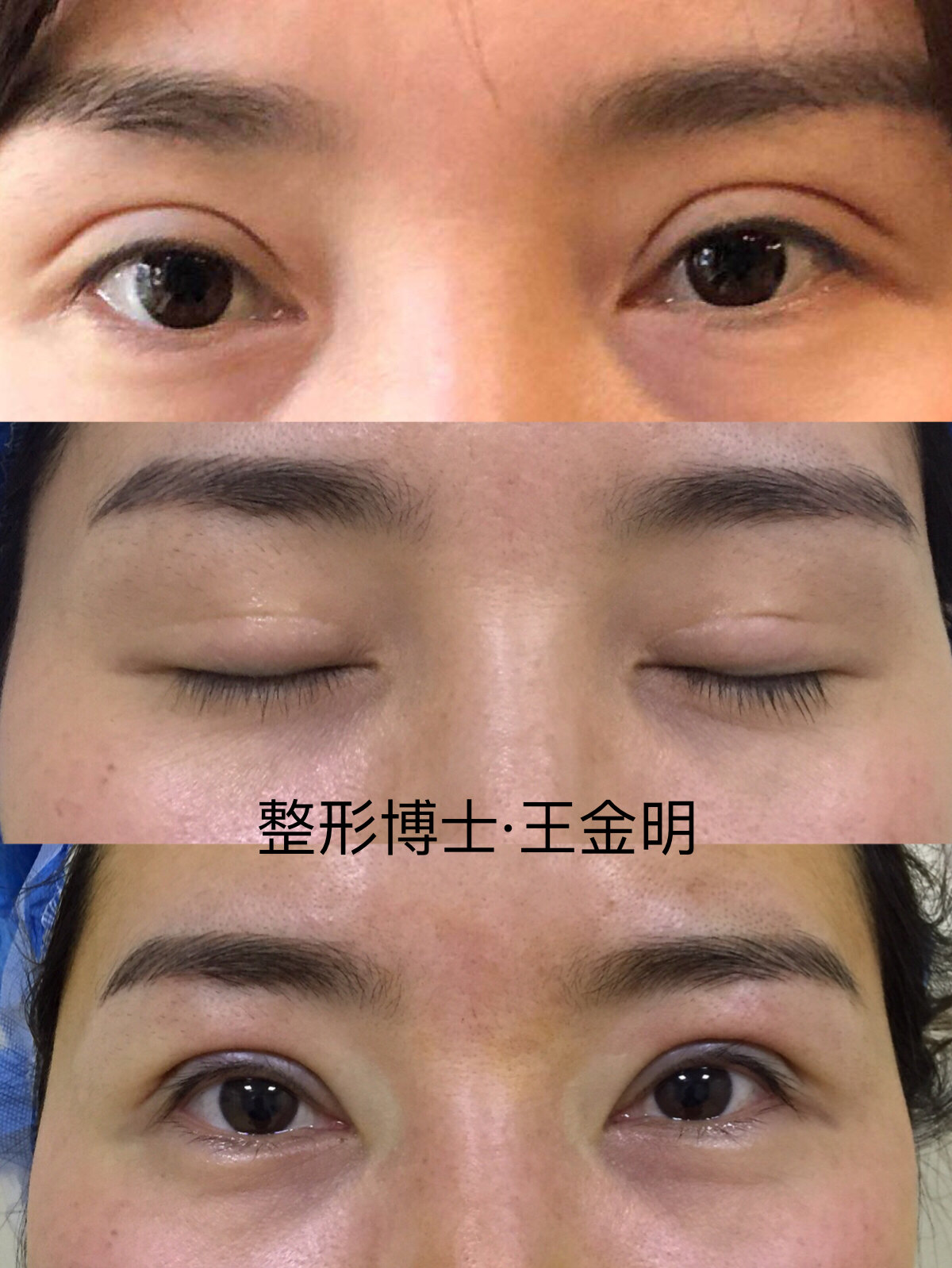 王金明修復雙眼皮案例
