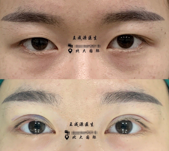北大國際整形王成源雙眼皮修復(fù)技術(shù)怎么樣