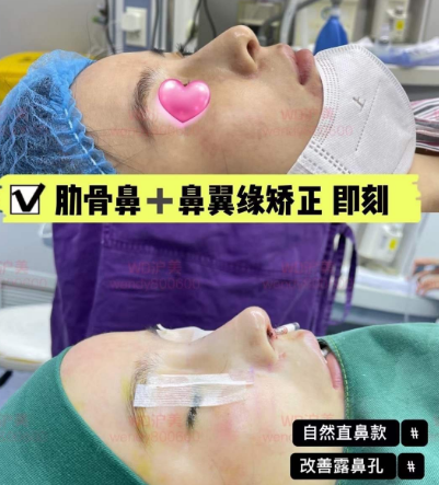 上海李章醫(yī)生做的鼻子怎么樣