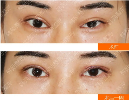 北京雙眼皮修復最牛的醫生是誰