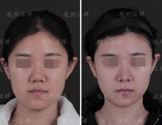 杭州汪垟做鼻修復技術好嗎