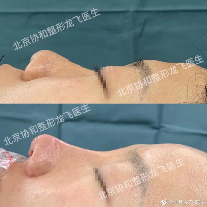 龍飛鼻修復案例