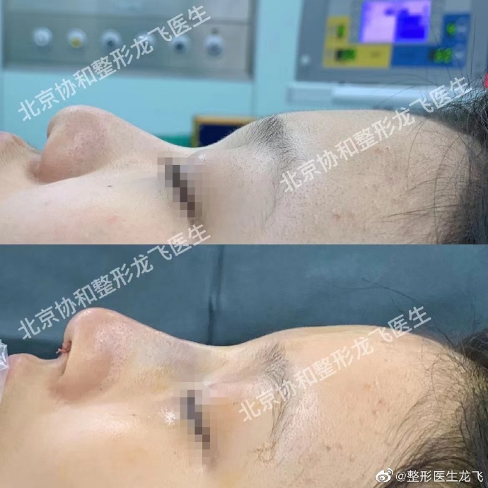 龍飛鼻修復案例