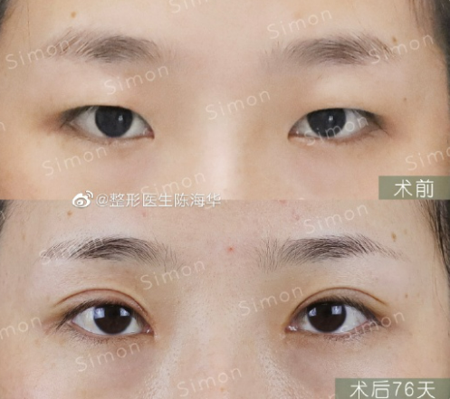 陳海華雙眼皮案例