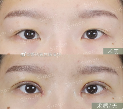 陳海華做雙眼皮修復案例