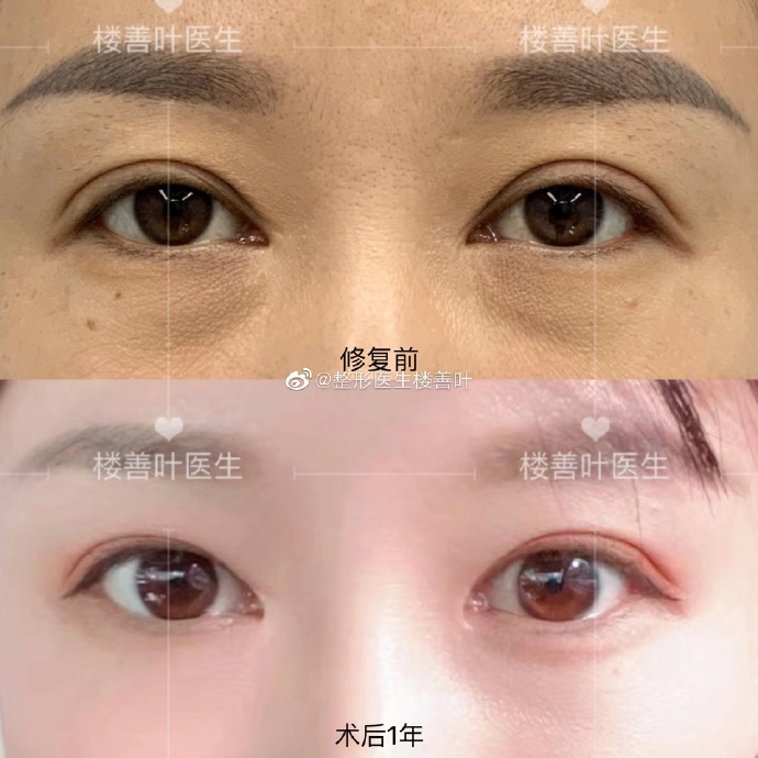 杭州樓善葉包內(nèi)眼角怎么樣