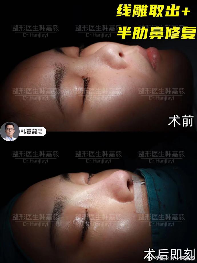韓嘉毅鼻修復案例
