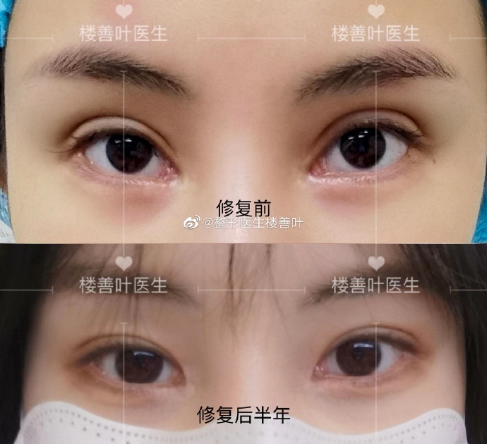 樓善葉和張冰潔誰修復內眼角更厲害