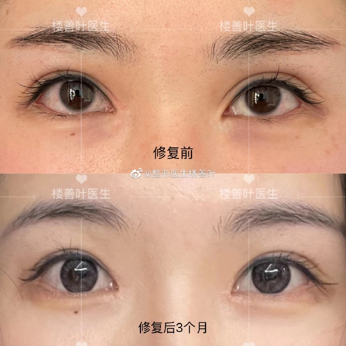 樓善葉修復內眼角案例