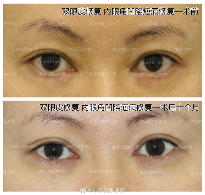 張冰潔修復內眼角案例