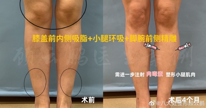 八大處哪個醫(yī)生做抽脂好