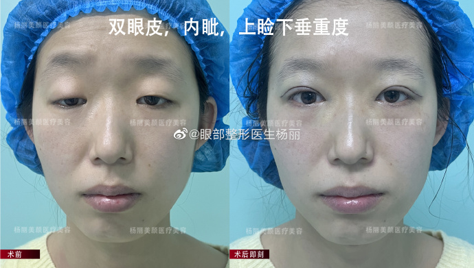 楊麗眼修復案例