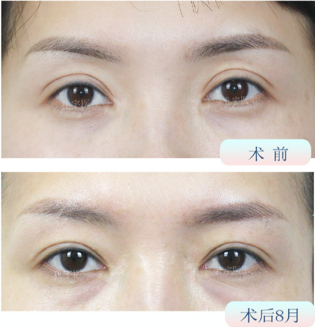 鄭州眼修復孔宇和楊麗誰技術更好