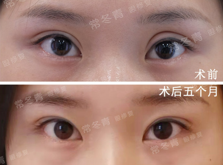 常冬青眼修復案例