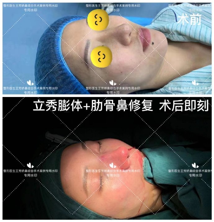 王芳嬌鼻修復案例